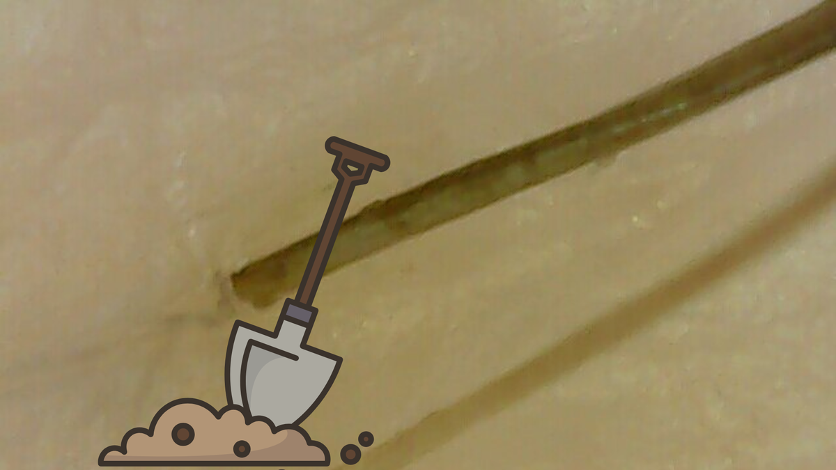 Operation Ingrown Drags Into Day 3 As Hair Begins Digging Trench Line